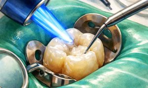 Особенности пломбирования зубов